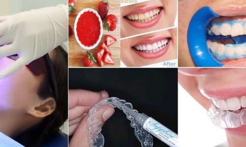 Sản phẩm làm trắng răng cấp tốc: Nguy hiểm khôn lường phía sau lời quảng cáo có cánh