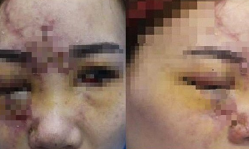 Biến chứng nặng nề khi tiêm filler 'đội lốt' collagen