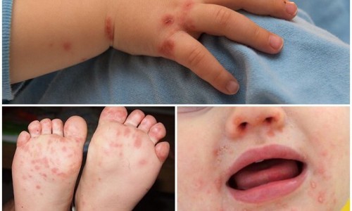 Gia tăng các ca tay chân miệng tại Hà Nội