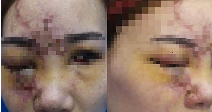 Biến chứng nặng nề khi tiêm filler 'đội lốt' collagen